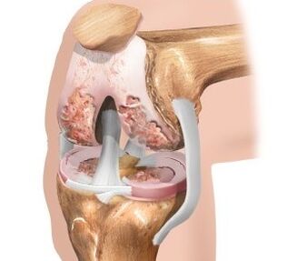 Der Knorpel ist im Knie