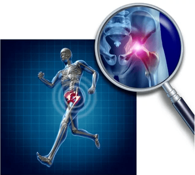 Arthrose der Hüftgelenke