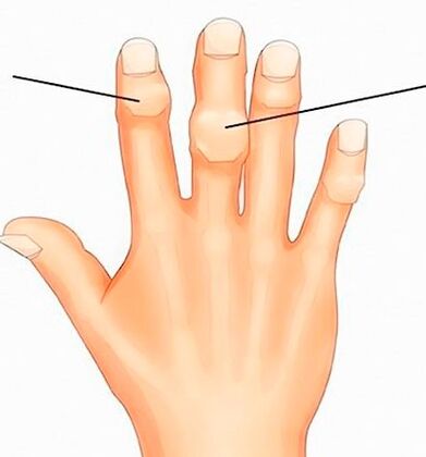 Heberden- und Bouchard-Knoten an den Interphalangealgelenken mit Arthrose