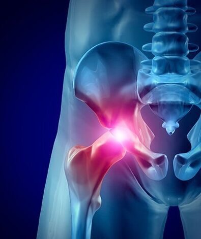 Hüftschmerzen Foto 1