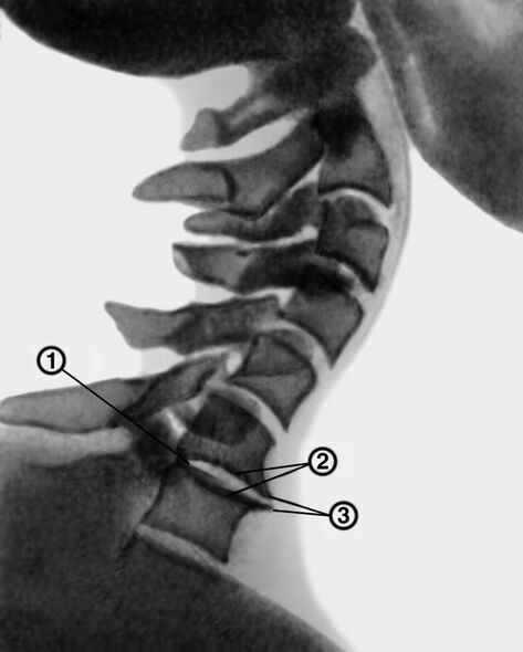 Röntgenaufnahme der Halswirbelsäule mit Osteochondrose