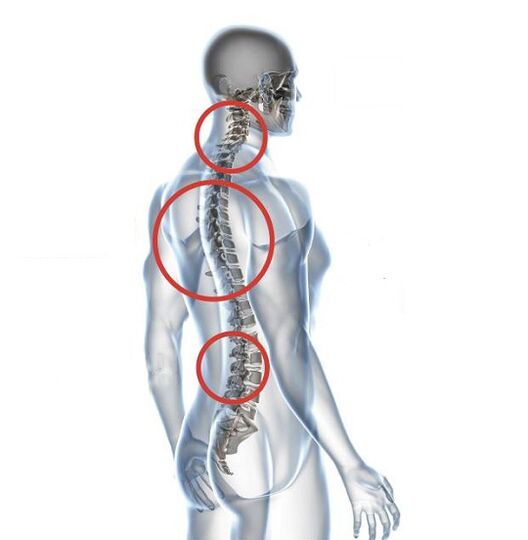 Wie äußert sich Osteochondrose